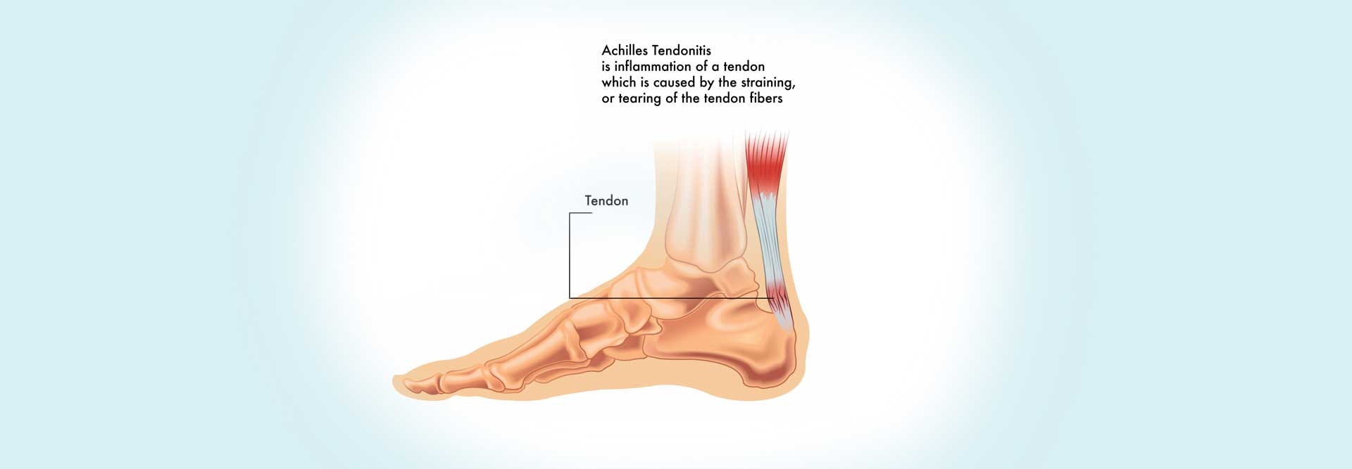 Achilles’ Tendonitis Injury - Cause, Symptoms &amp; Self-Healing Techniques