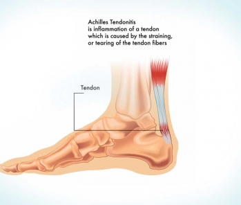 Achilles’ tendonitis injury and how bio energy therapy can help