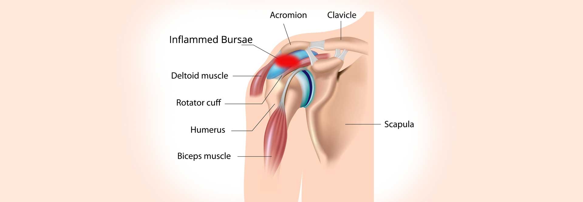 Shoulder Pain – Frozen Shoulder - Symptoms &amp; Cause - Self Healing Course