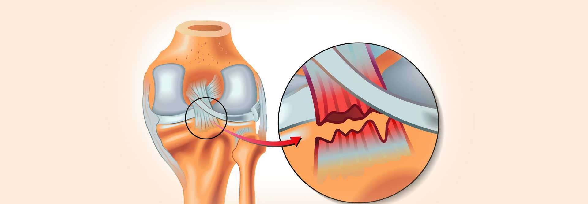 Self-Healing Knee Posterior cruciate ligament Injury - Self Healing Course