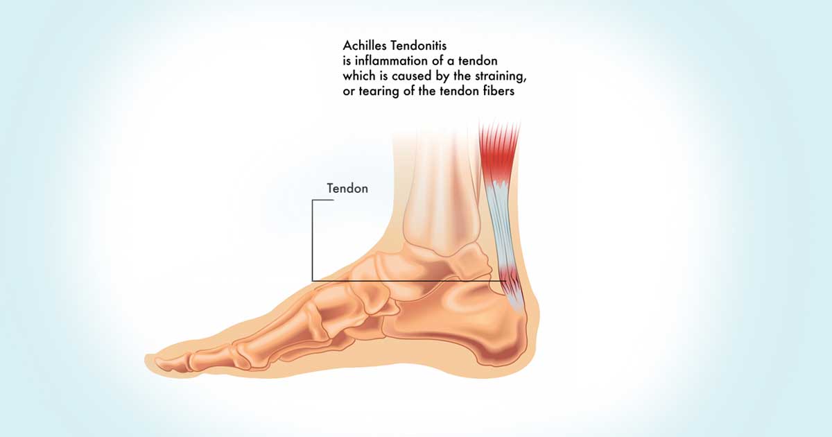 Achilles’ Tendonitis Injury - Cause, Symptoms & Self-Healing Techniques ...